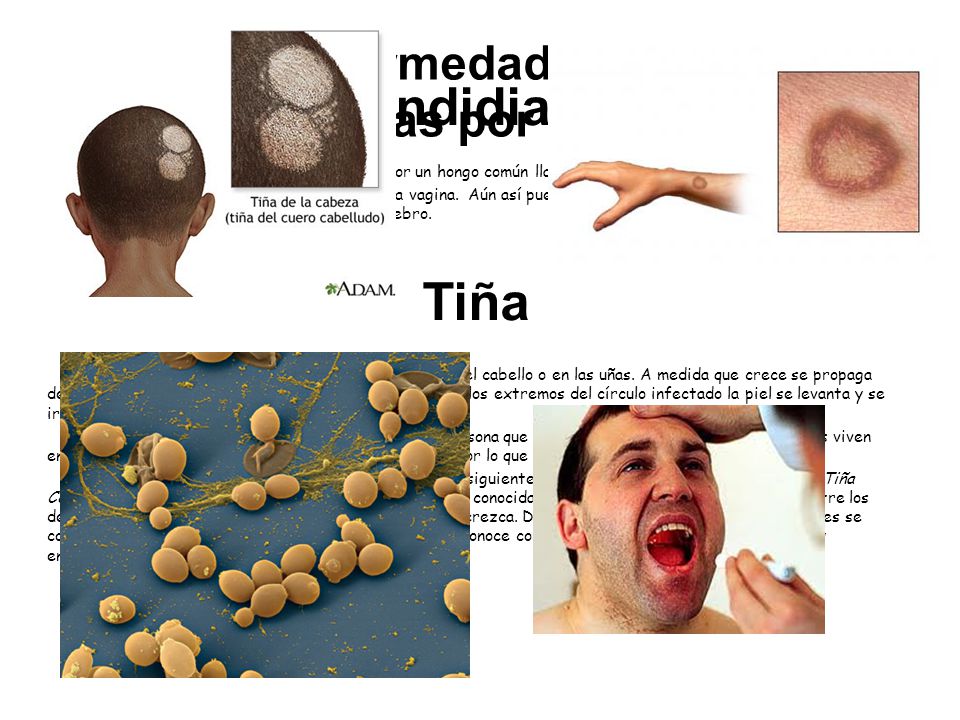 El medio barato del hongo de los dedos de los pies